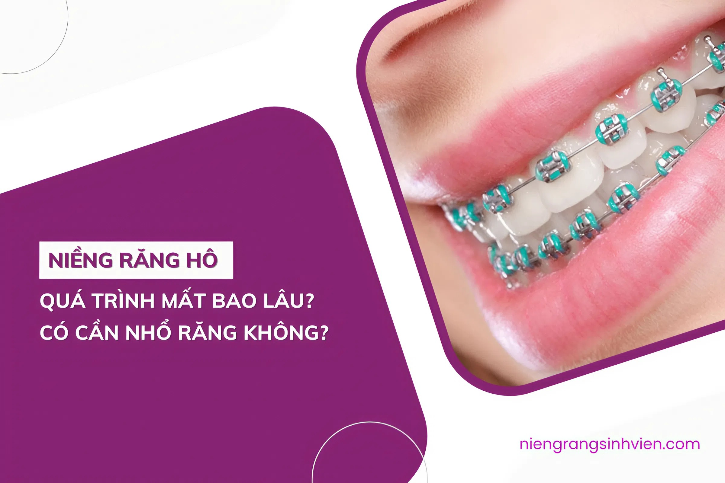 niềng răng hô mất bao lâu