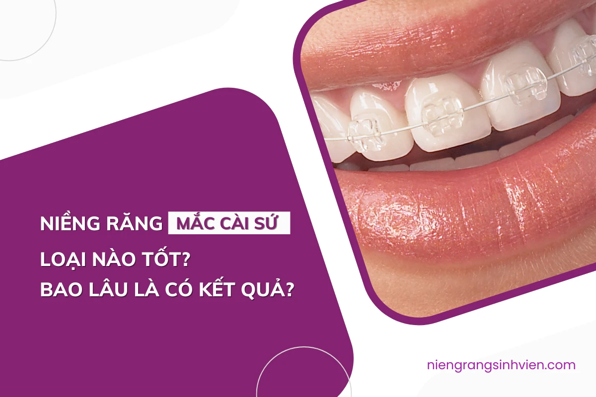 niềng răng mắc cài sứ