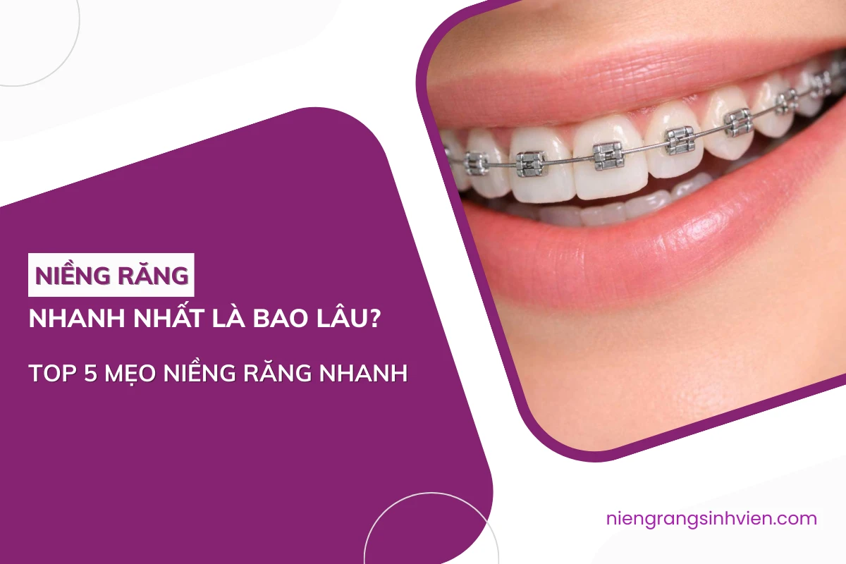 thời gian niềng răng nhanh nhất là bao lâu