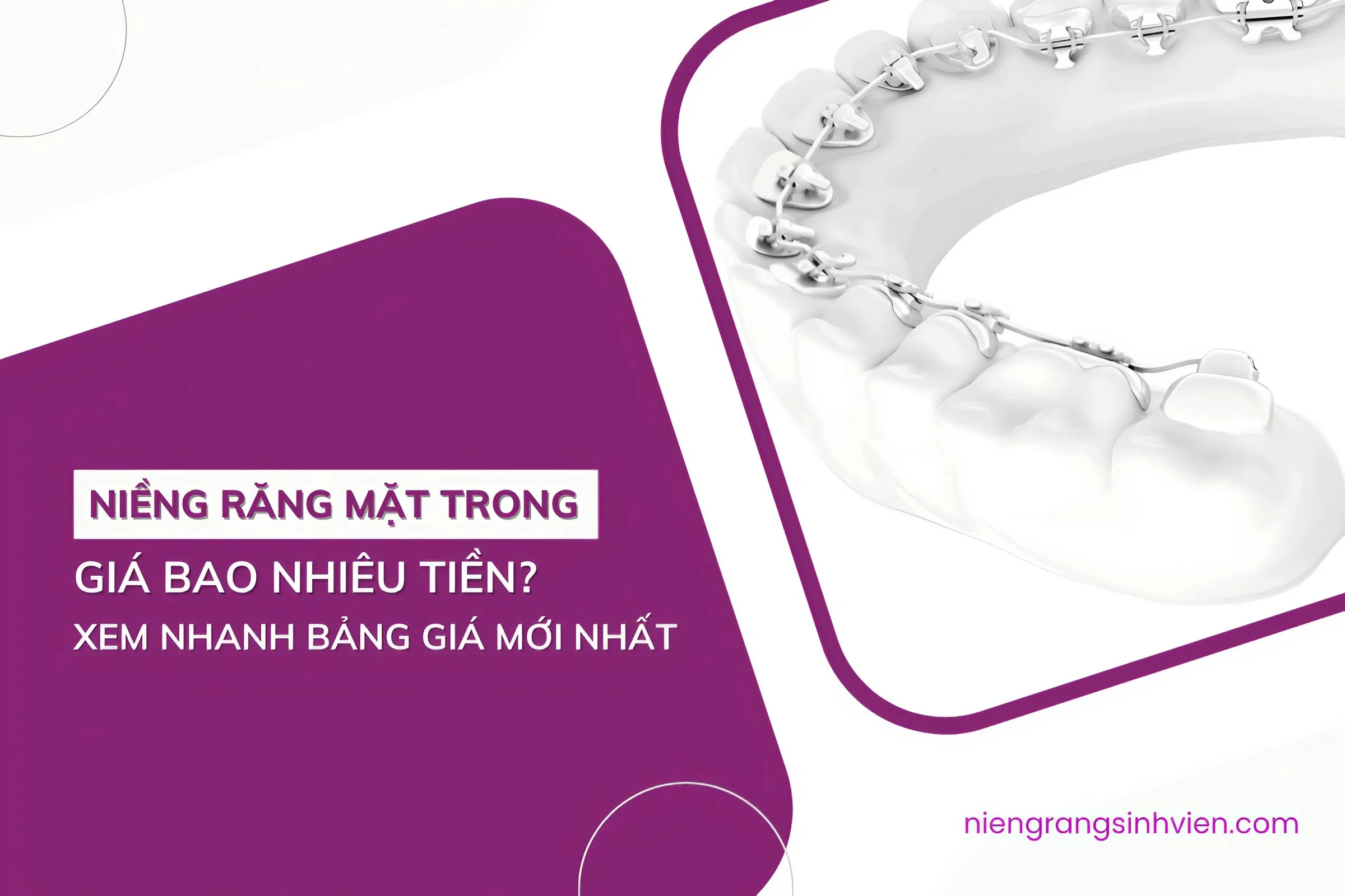 niềng răng mặt trong giá bao nhiêu