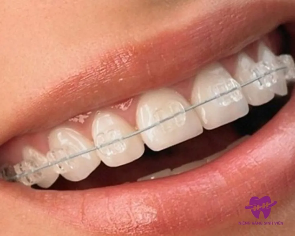 giá niềng răng mắc cài pha lê