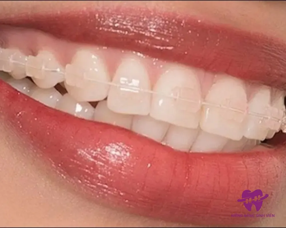 giá niềng răng mắc cài pha lê