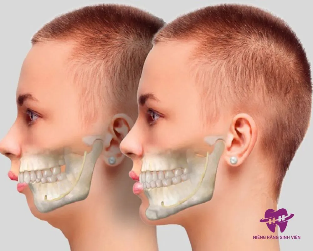 giá niềng răng mắc cài pha lê