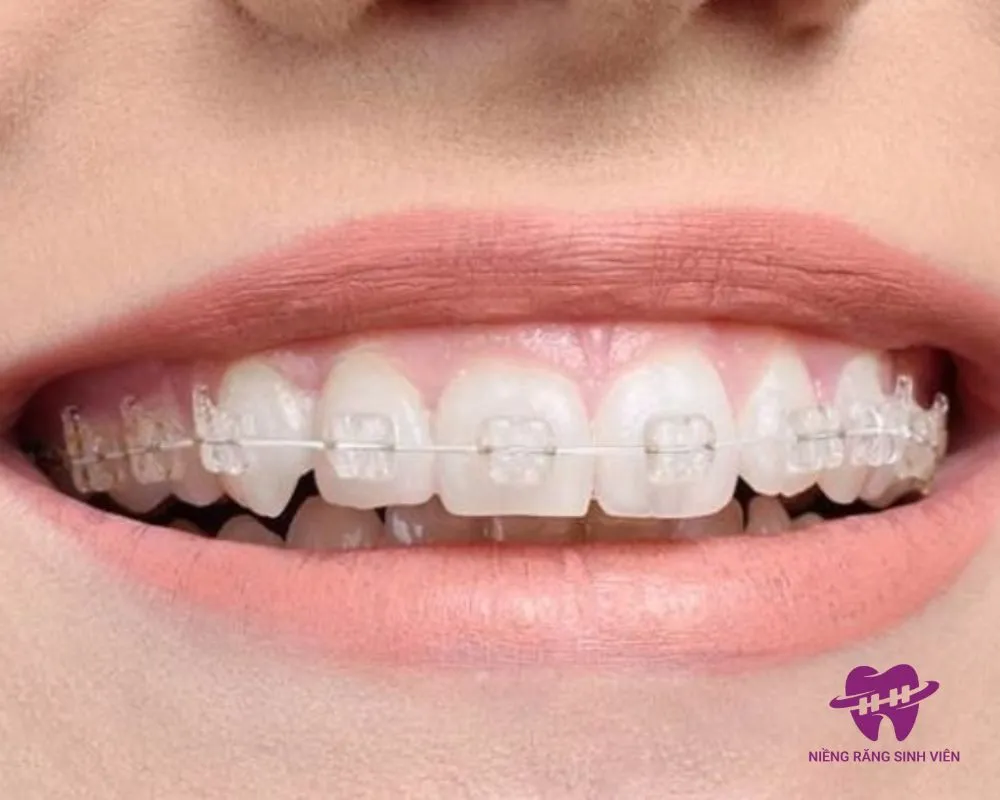 giá niềng răng mắc cài pha lê