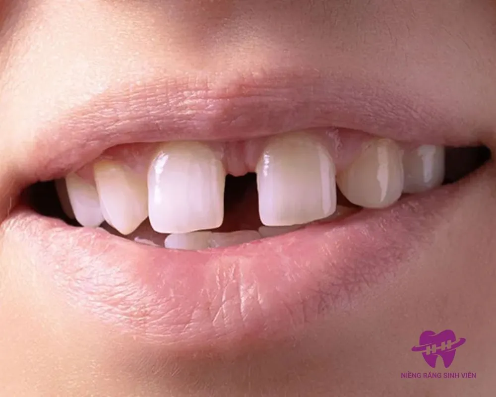 giá niềng răng mắc cài pha lê