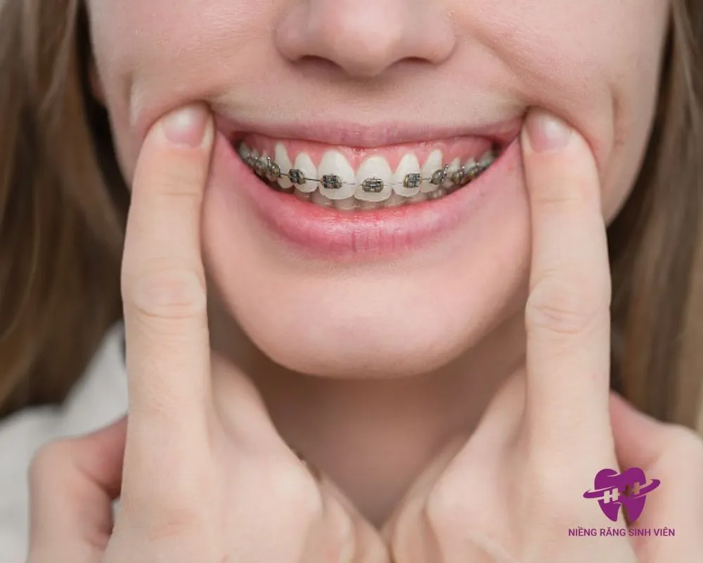 niềng răng trả góp trả trước bao nhiêu