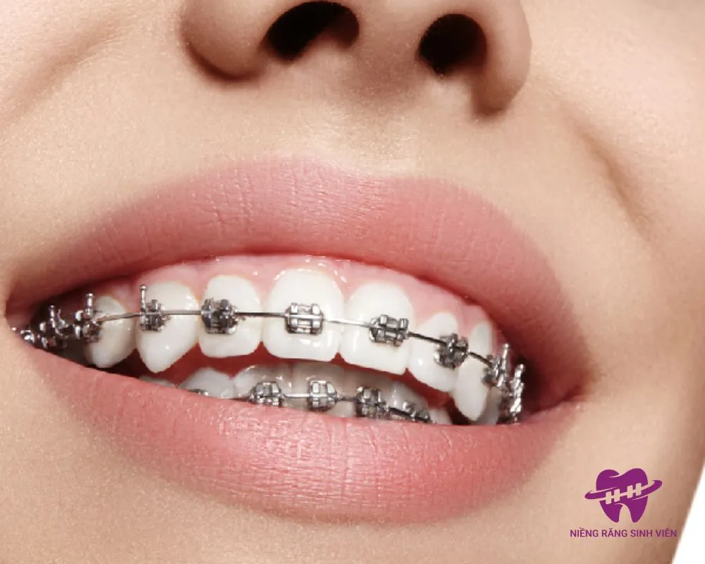 niềng răng trả góp trả trước bao nhiêu