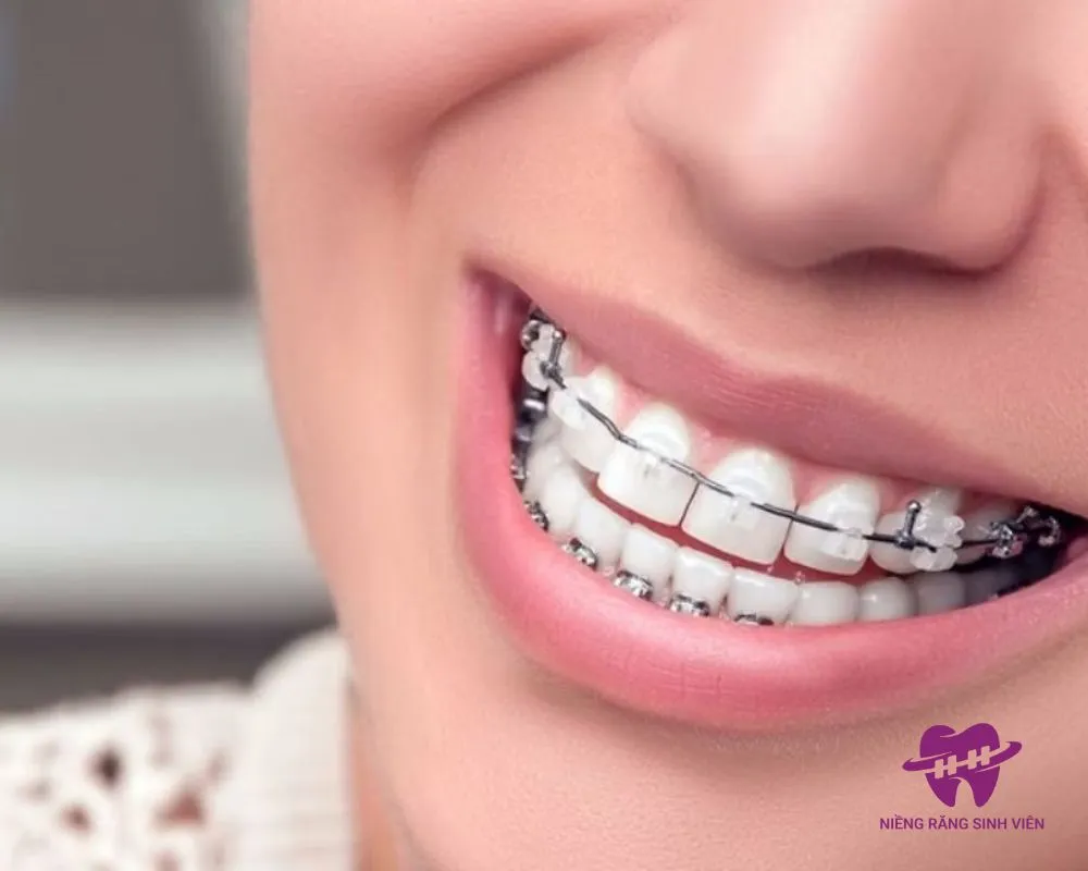 niềng răng trả góp trả trước bao nhiêu