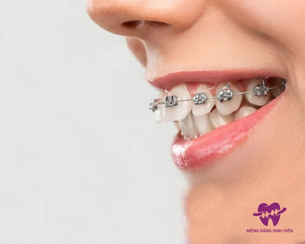 niềng răng trả góp trả trước bao nhiêu