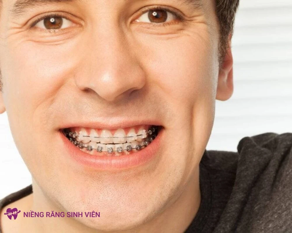 40 tuổi có niềng răng được không