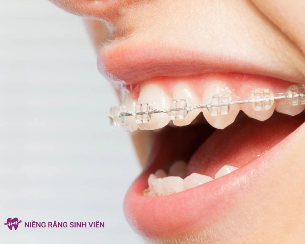 40 tuổi có niềng răng được không