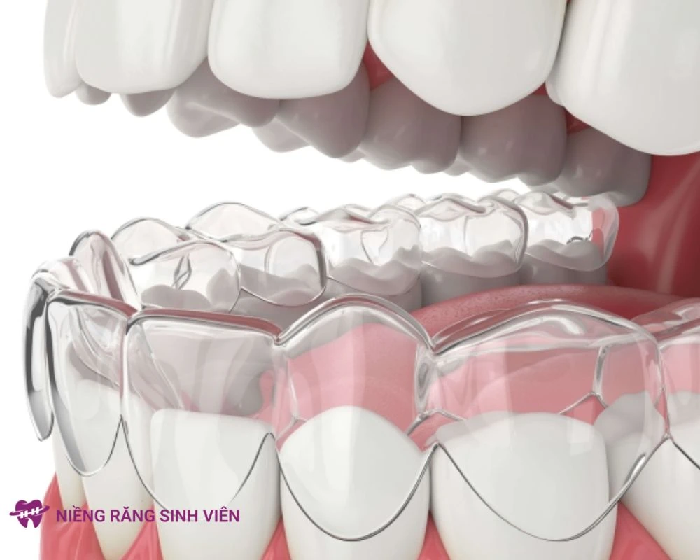 các loại niềng răng trong suốt