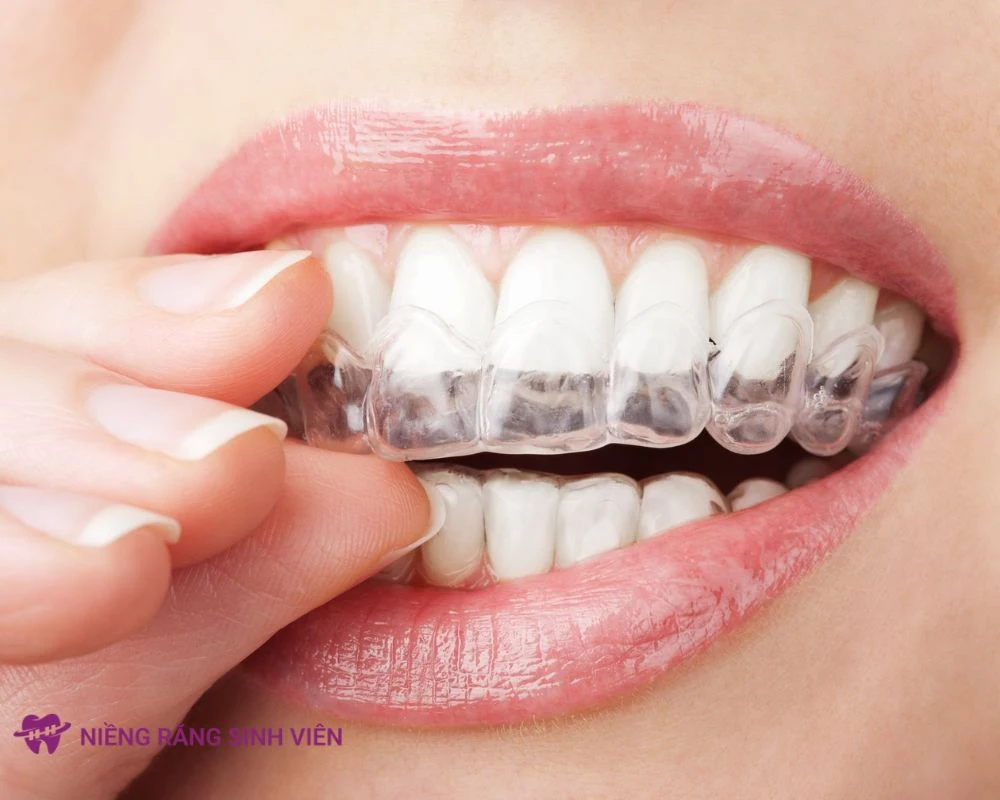 các loại niềng răng trong suốt