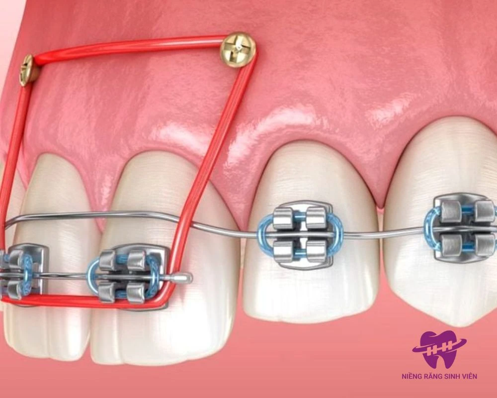 cắm vít niềng răng bao lâu thì tháo