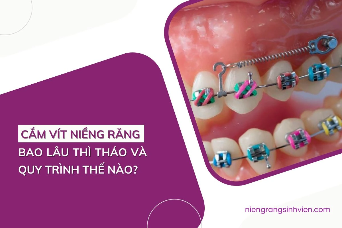cắm vít niềng răng bao lâu thì tháo