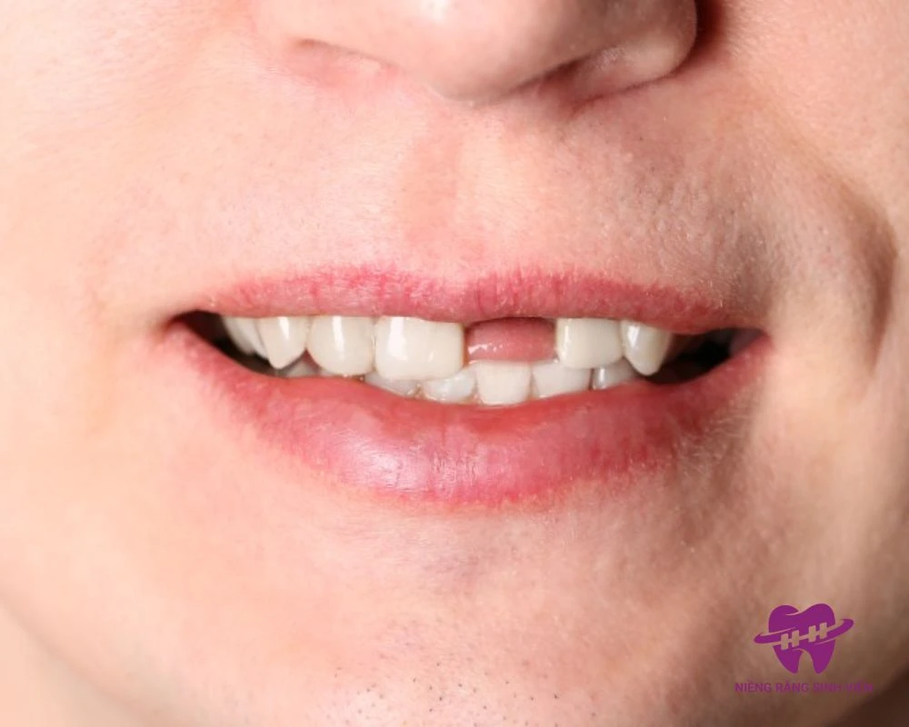 mất răng cửa có niềng được không