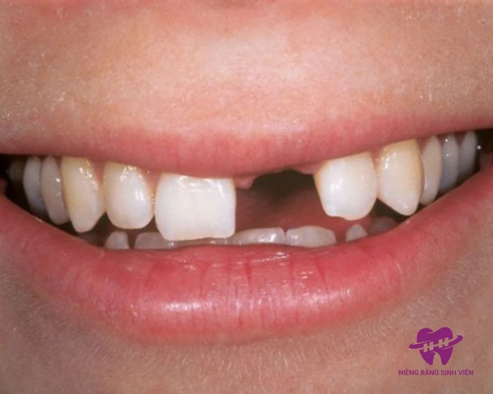 mất răng cửa có niềng được không