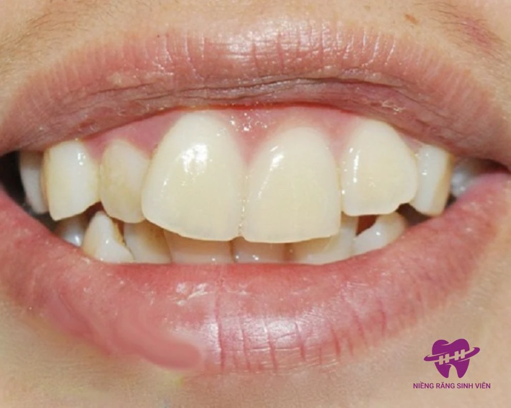 mất răng cửa có niềng được không