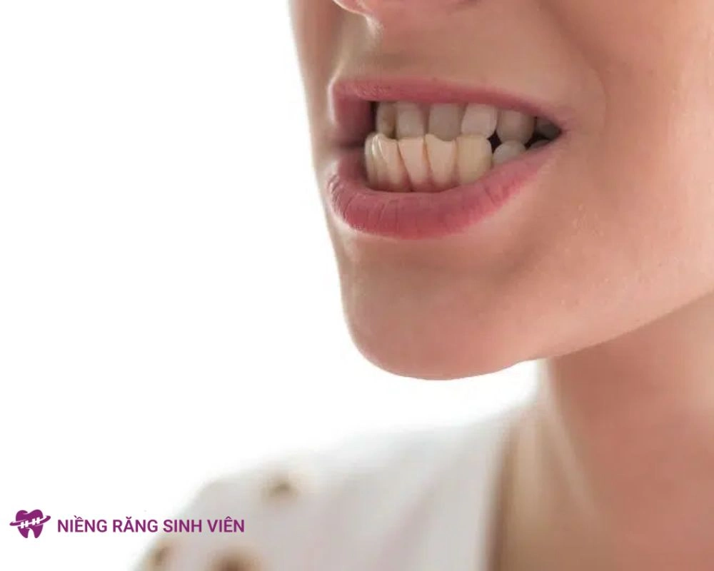 nâng khớp cắn trong niềng răng