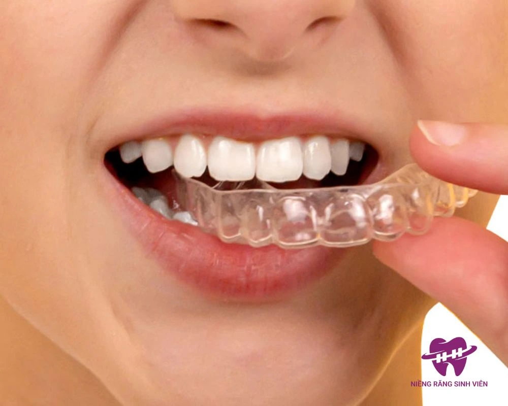 niềng răng hô tại nhà