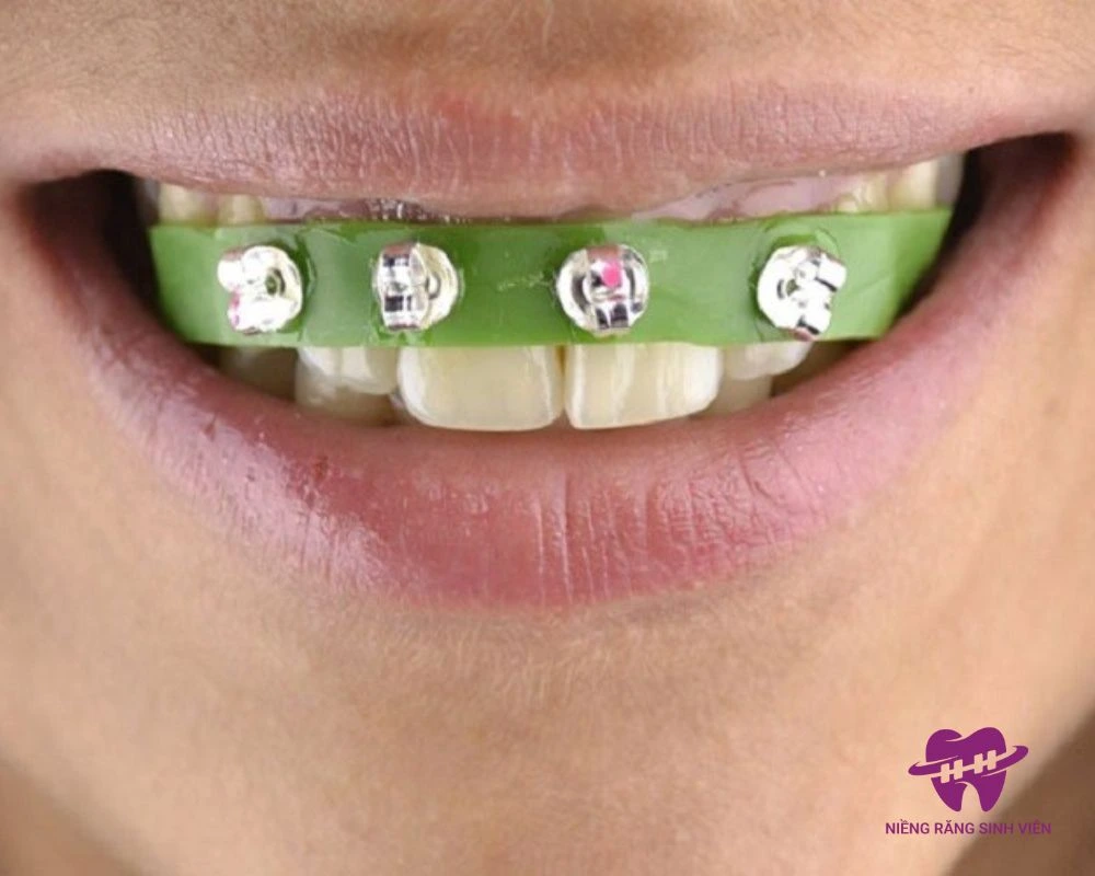 niềng răng hô tại nhà