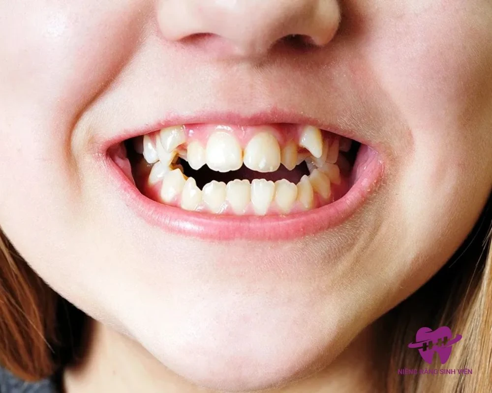 niềng răng khểnh bao nhiêu tiền