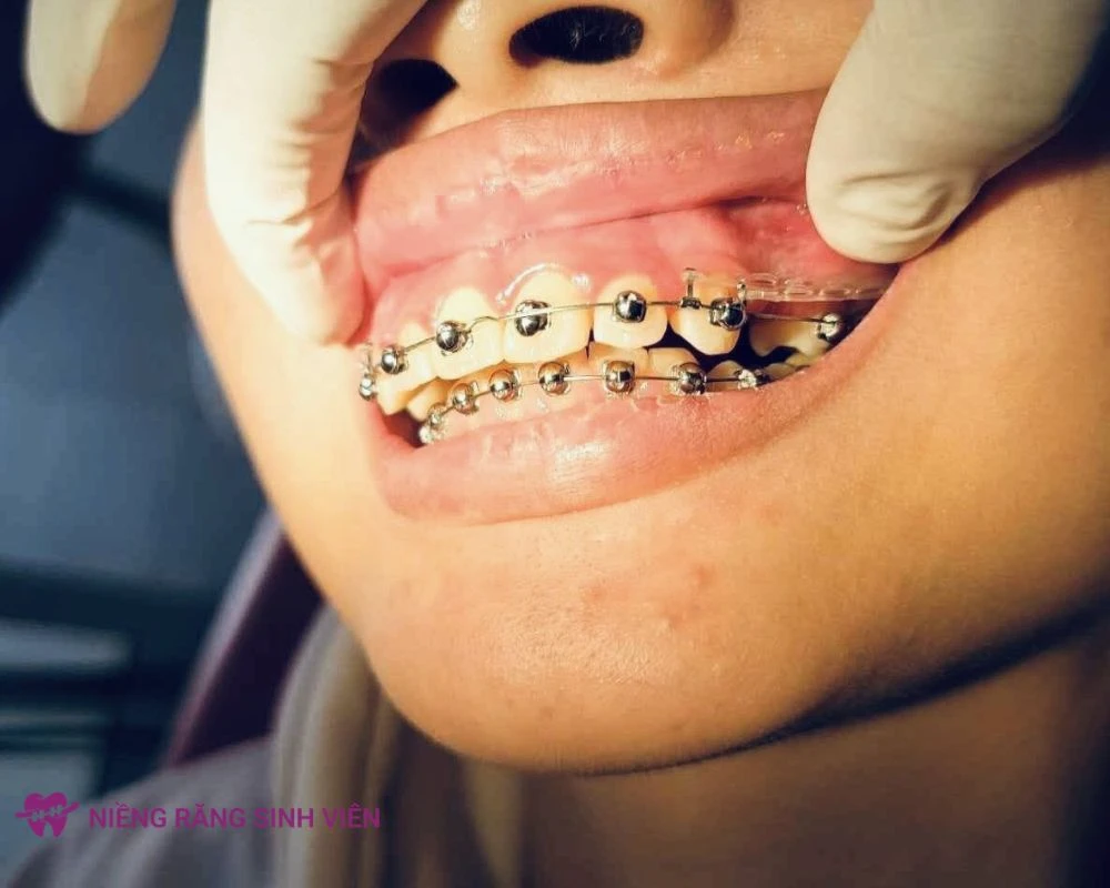 niềng răng mắc cài cánh cam