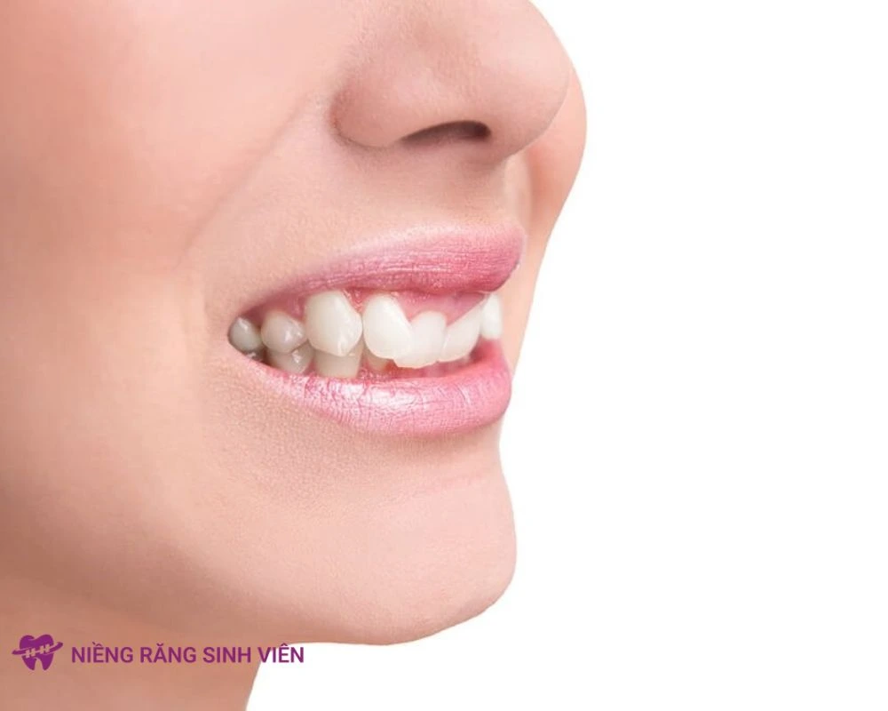 niềng răng mắc cài cánh cam
