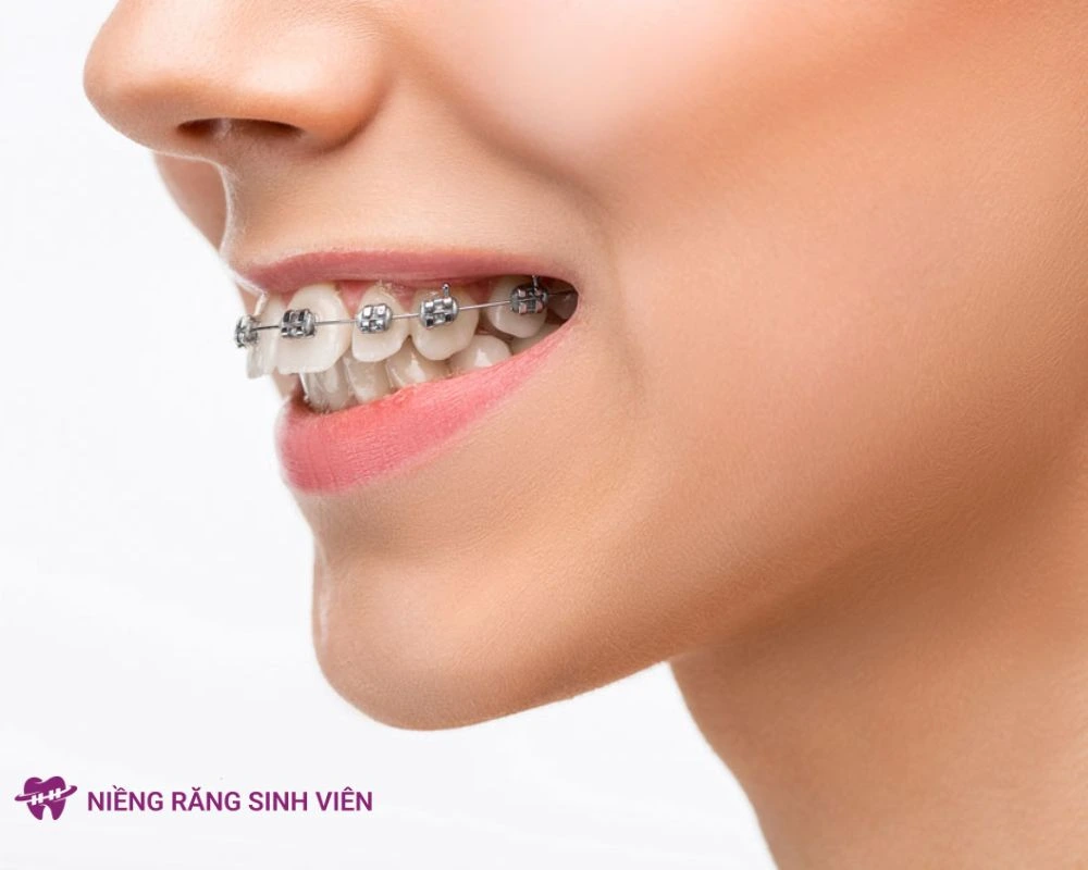 niềng răng mắc cài tự động
