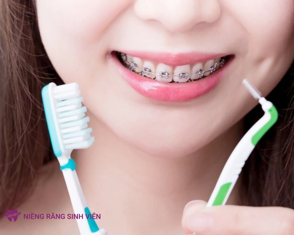 niềng răng mắc cài tự động