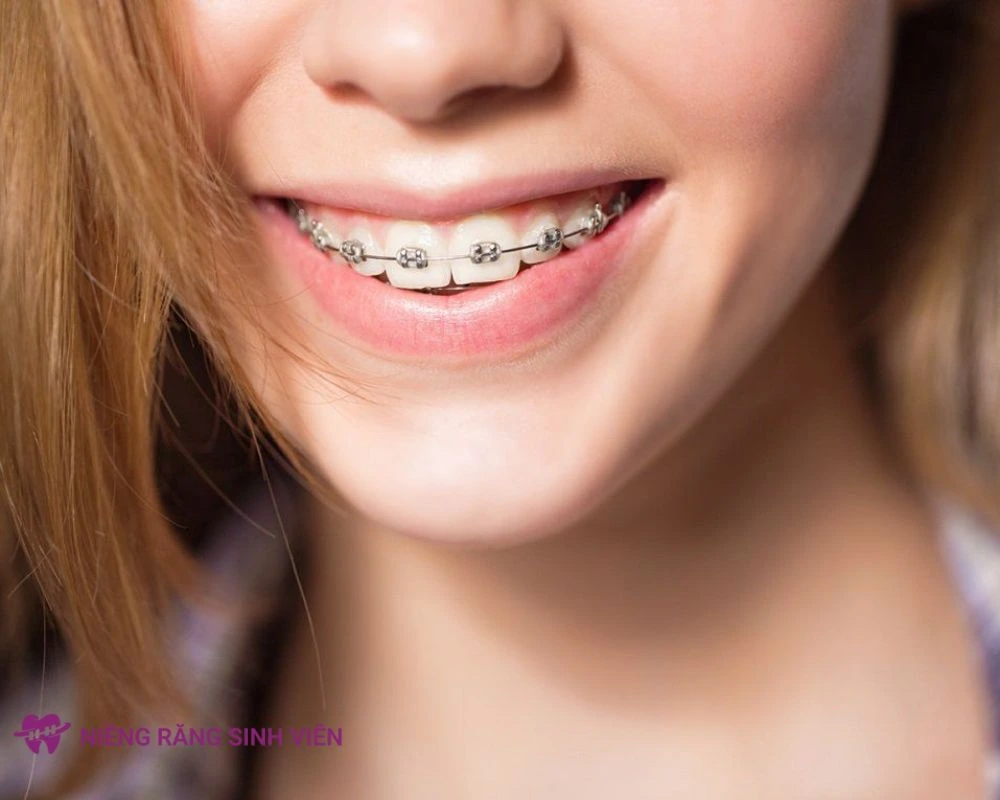 niềng răng mắc cài tự động