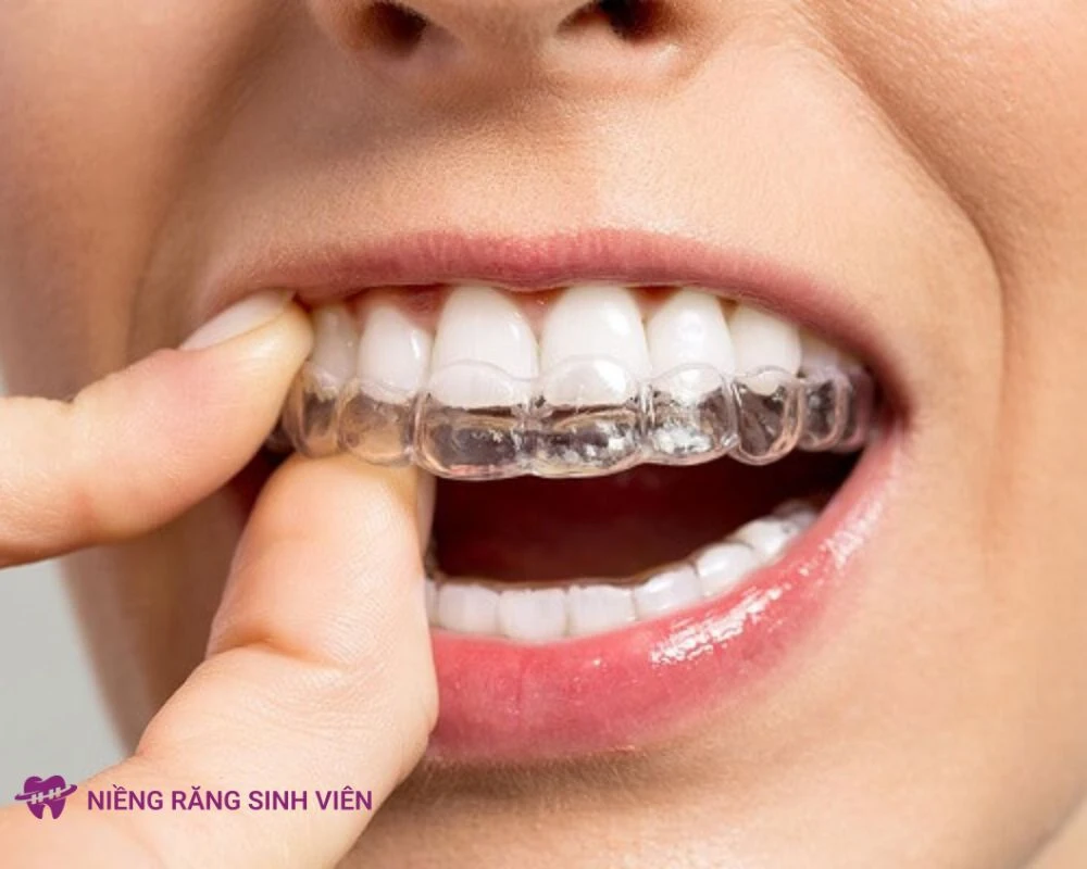 niềng răng trong suốt có đau không