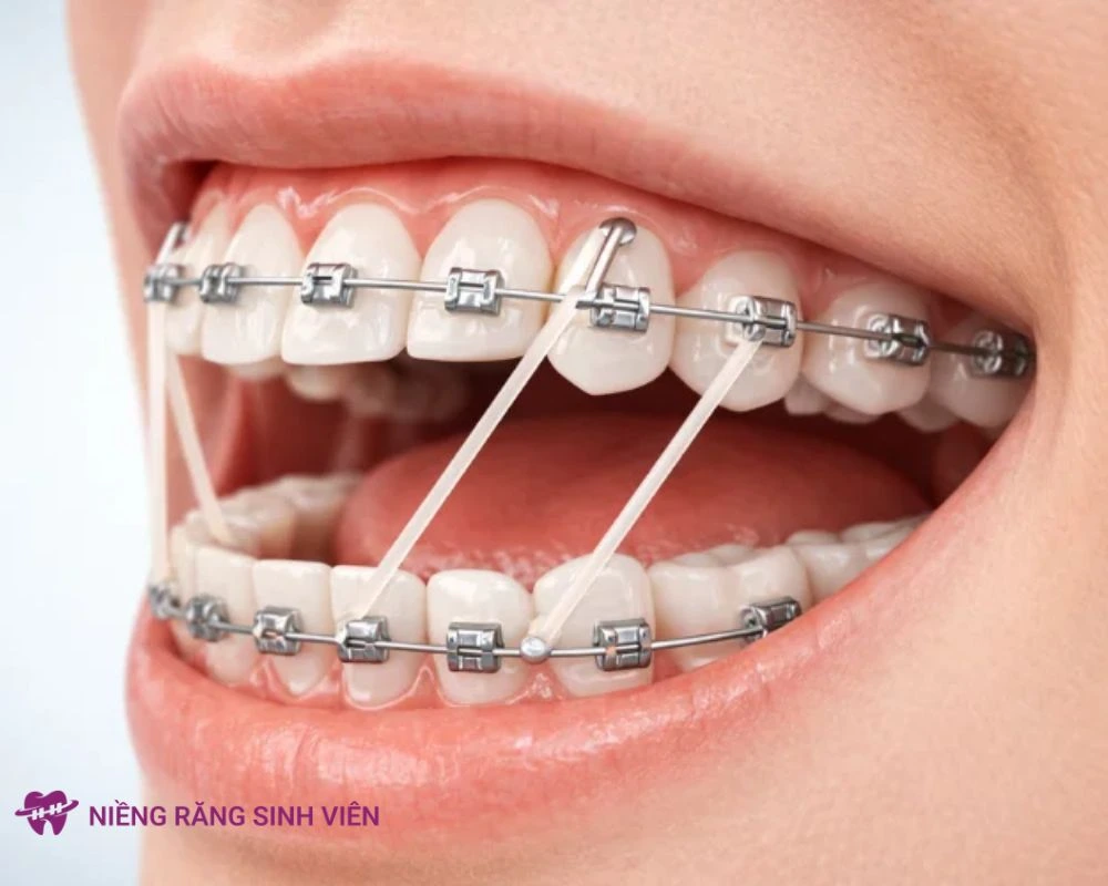 niềng răng xong bị móm