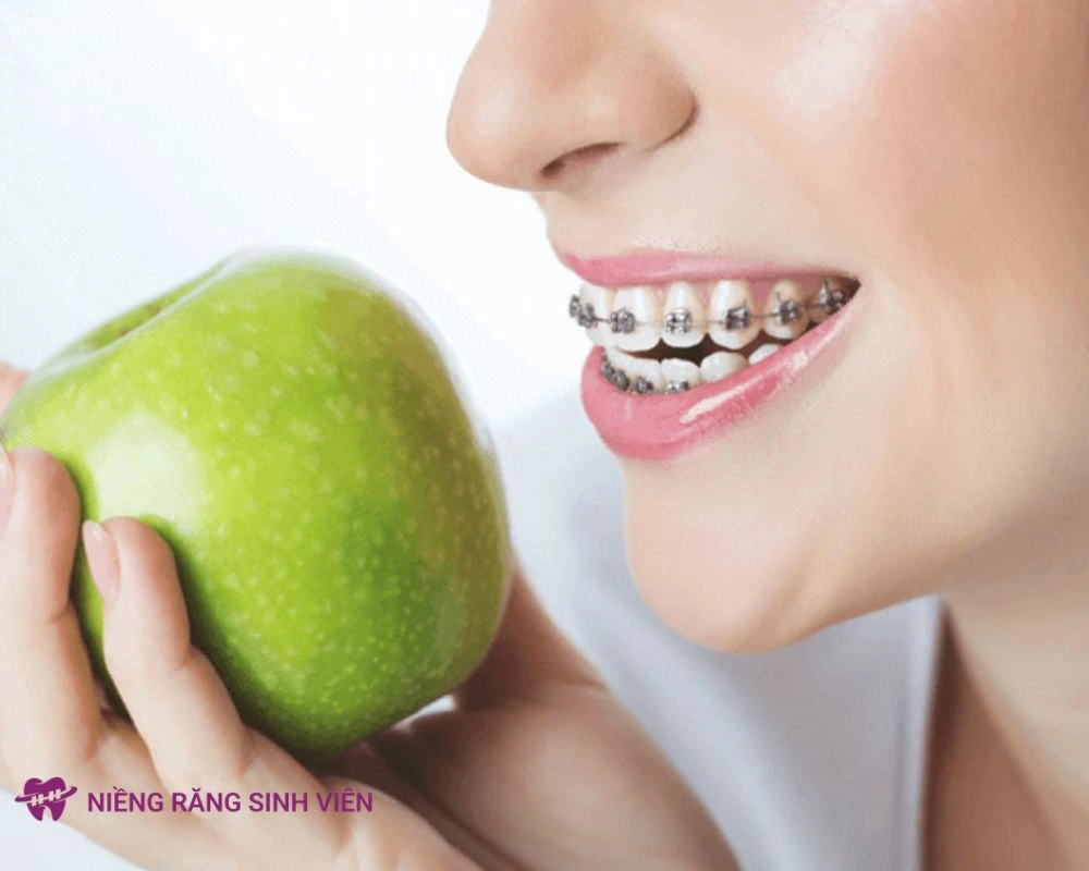 niềng răng xong bị móm
