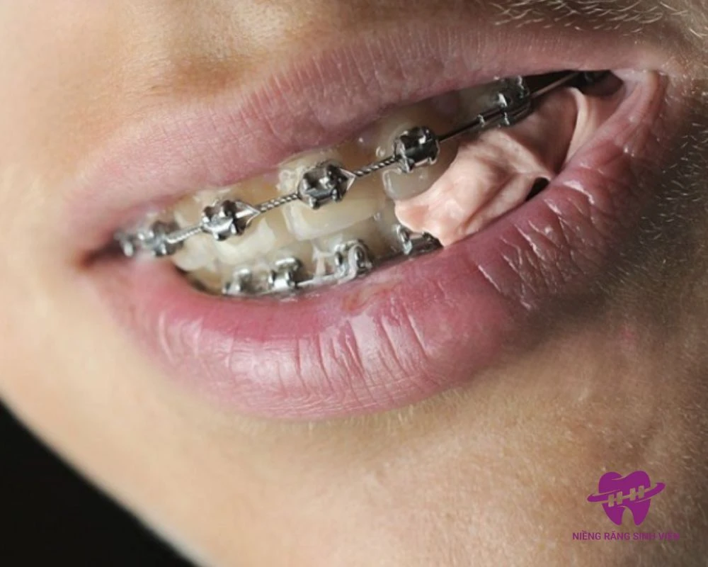 nuốt mắc cài niềng răng có sao không