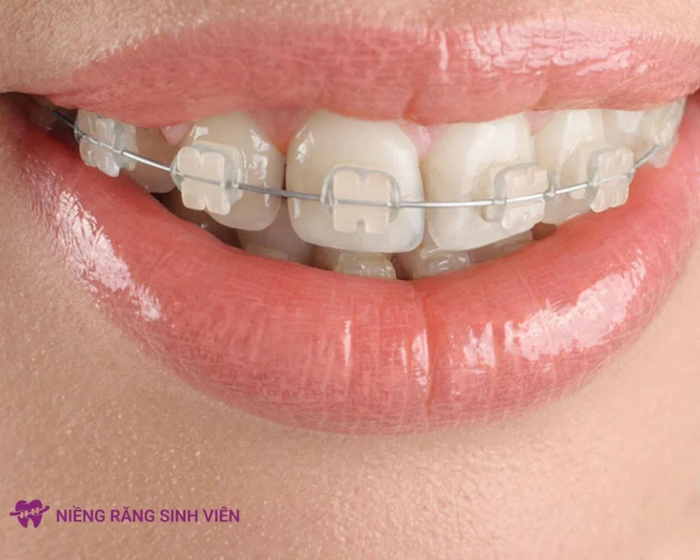 răng khểnh có nên niềng không