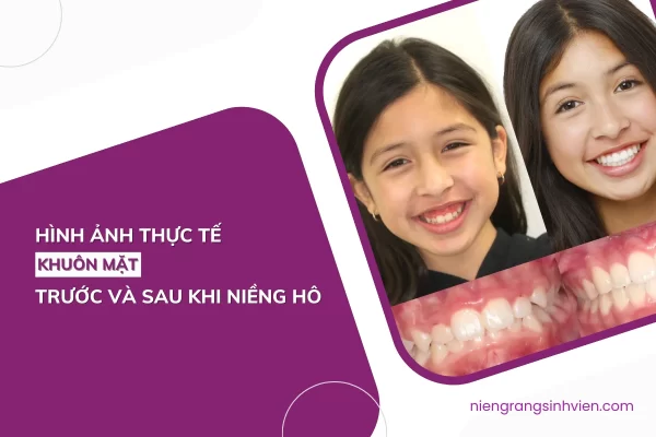 niềng răng hô trước và sau