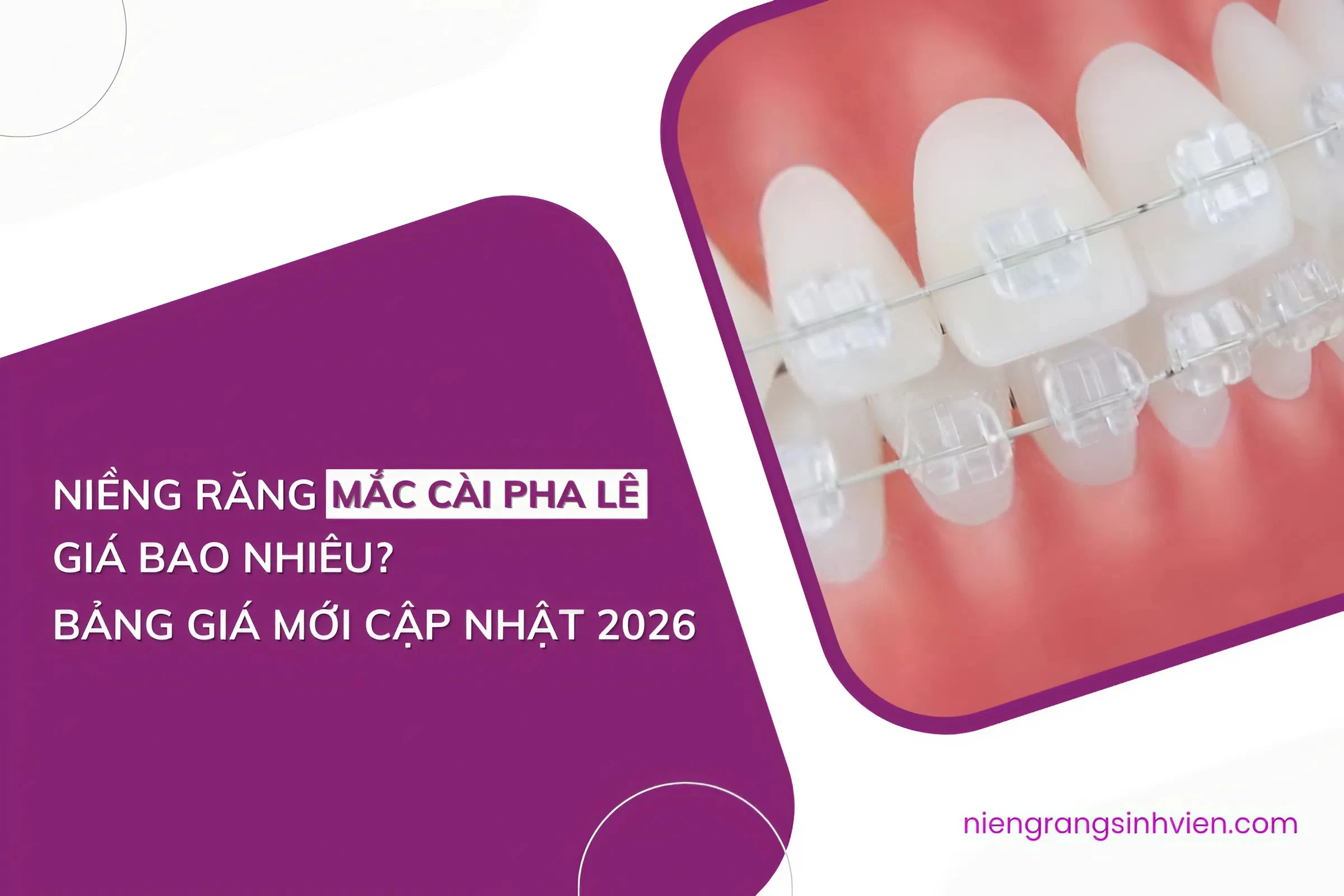 niềng răng mắc cài pha lê trong suốt