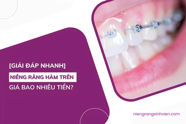 niềng răng hàm trên giá bao nhiêu