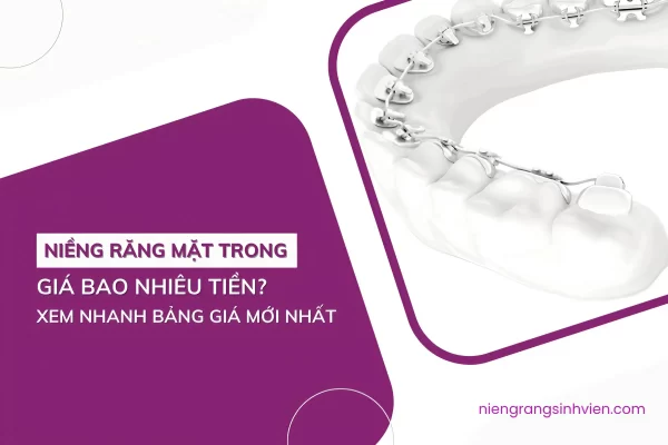 niềng răng mặt trong giá bao nhiêu