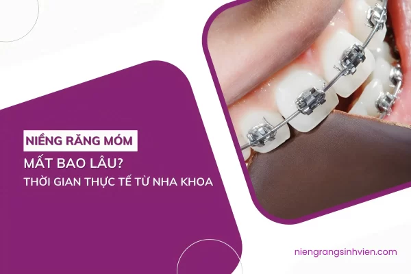 niềng răng móm mất bao lâu