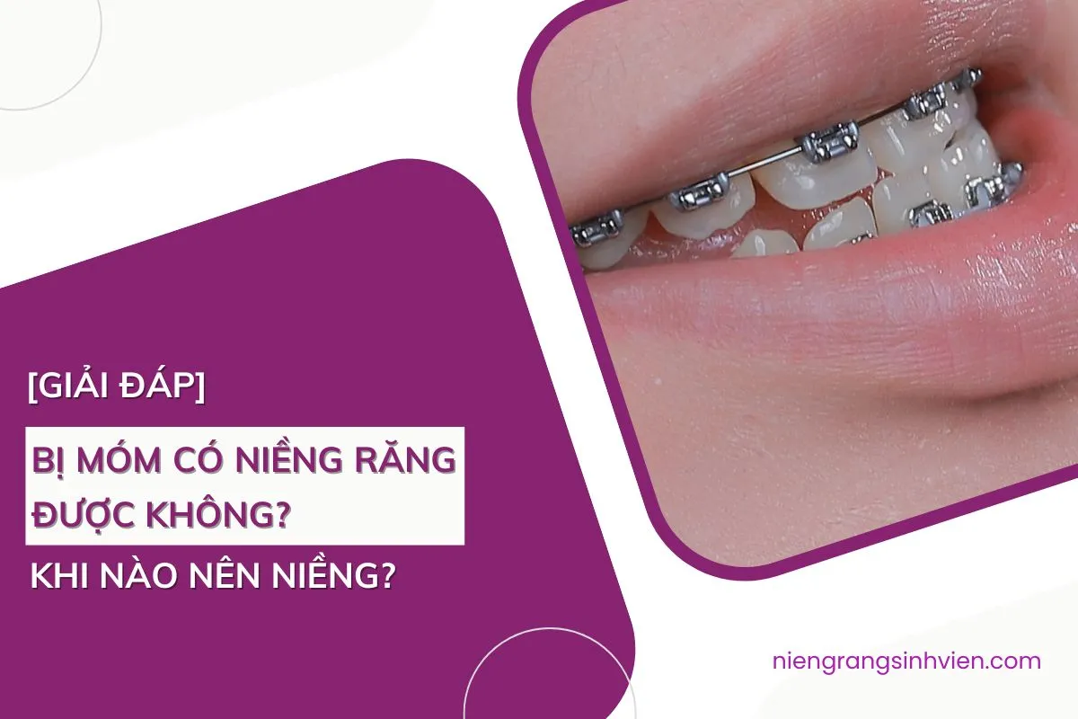 bị móm có niềng răng được không
