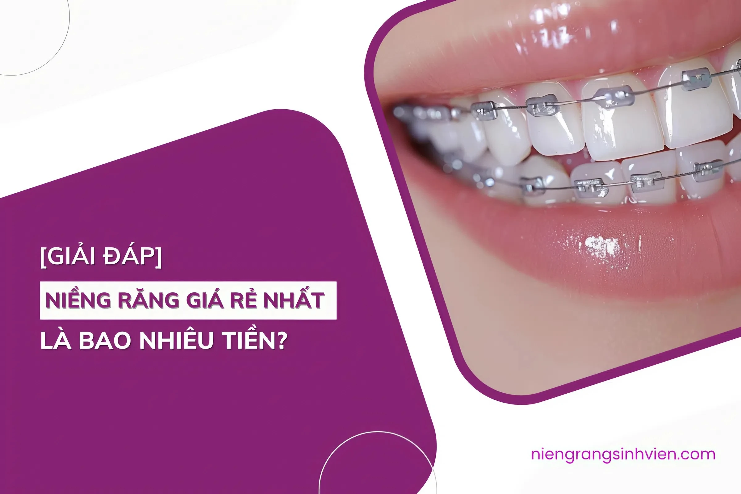 niềng răng giá rẻ