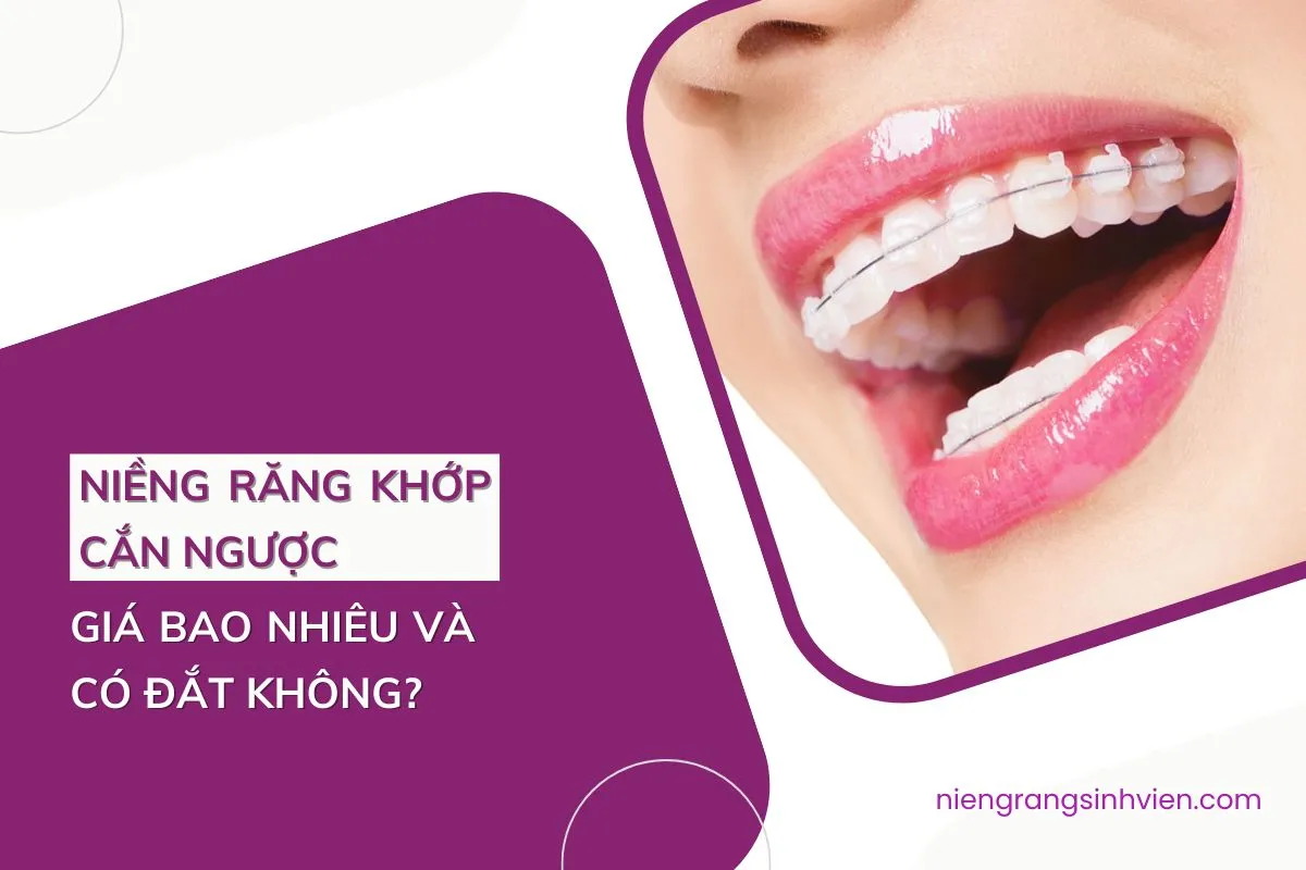 niềng răng khớp cắn ngược giá bao nhiêu