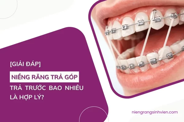 niềng răng trả góp trả trước bao nhiêu