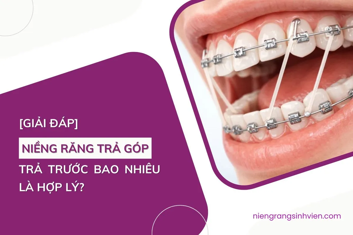 niềng răng trả góp trả trước bao nhiêu