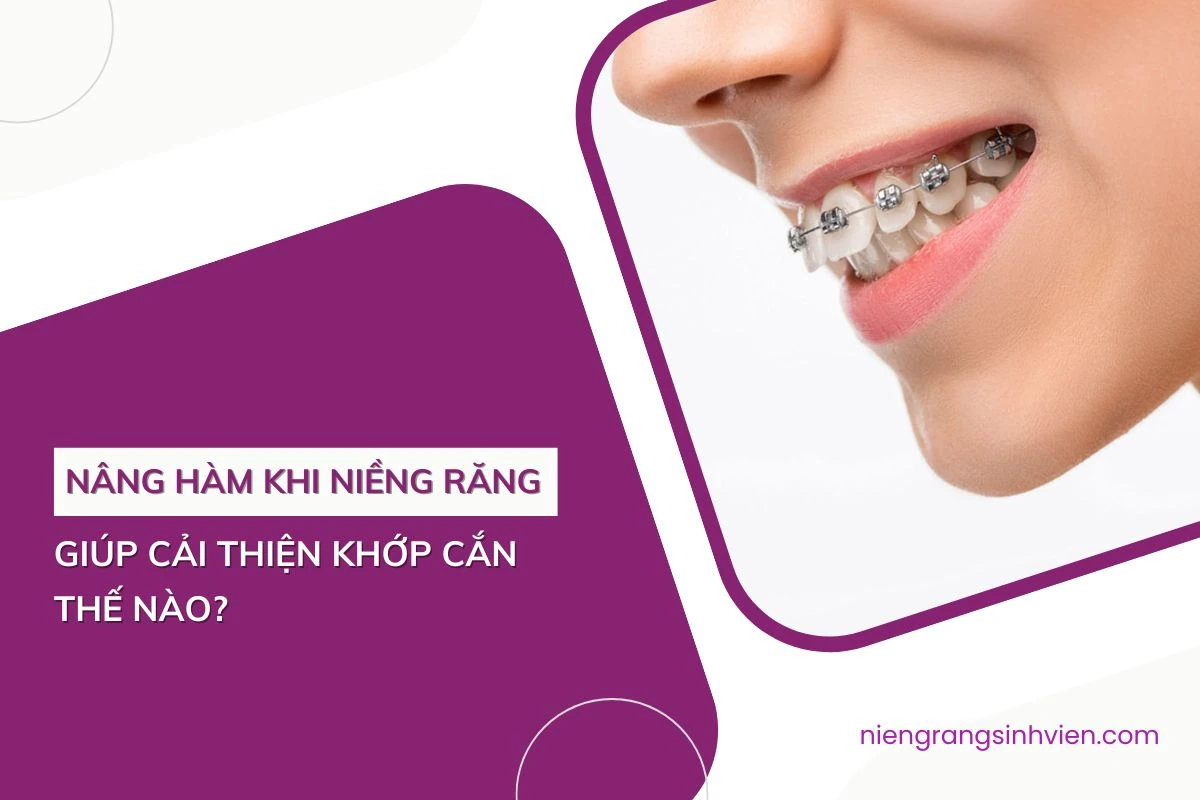 nâng hàm khi niềng răng