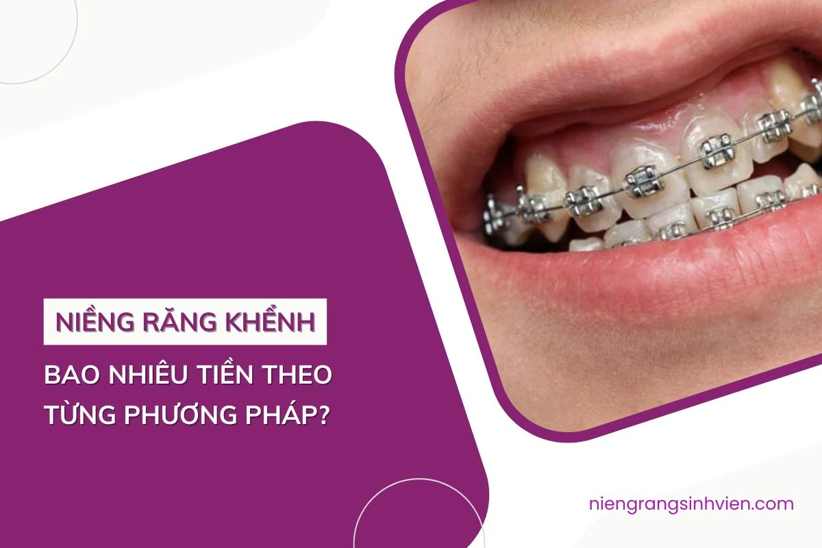 niềng răng khểnh bao nhiêu tiền