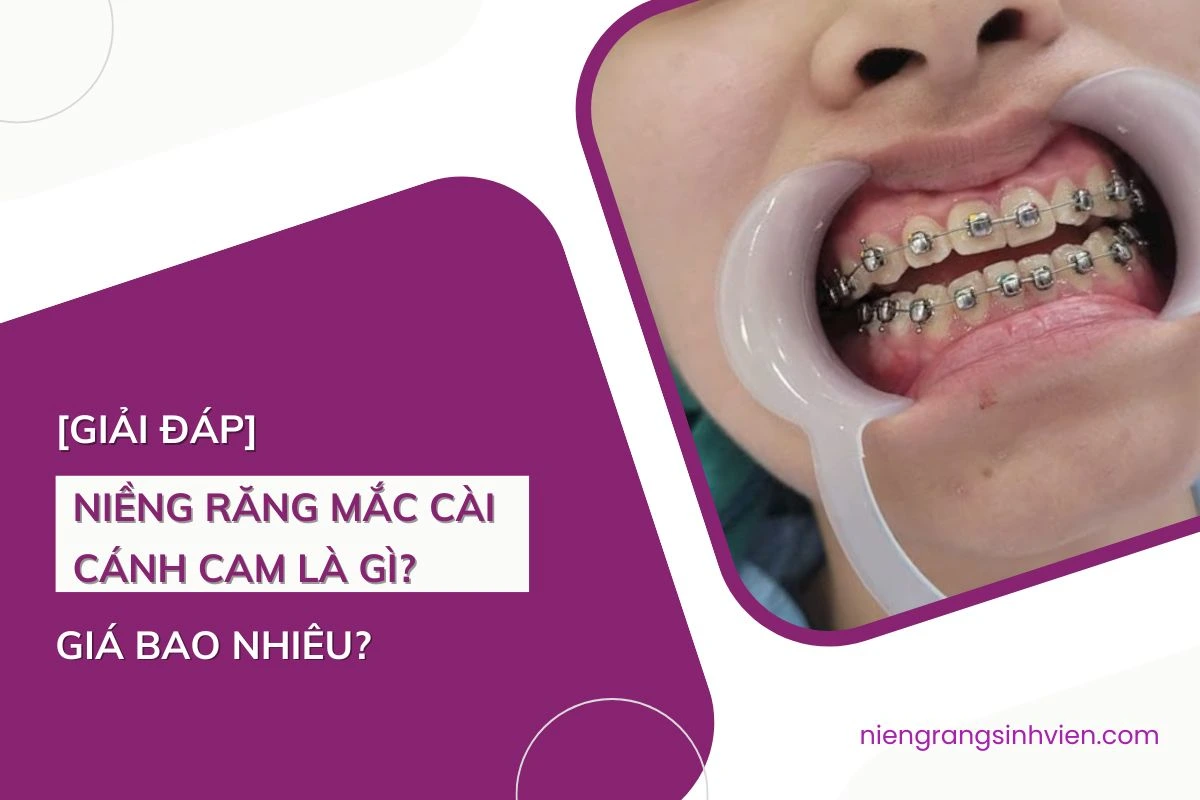 niềng răng mắc cài cánh cam