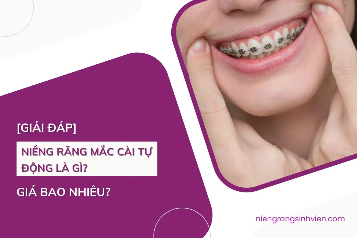 niềng răng mắc cài tự động